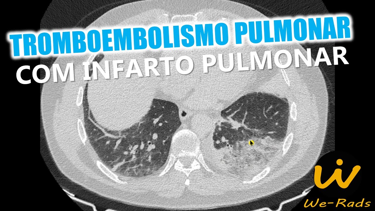 Tromboembolismo pulmonar (TEP) na angiotomografia de tórax com infarto pulmonar