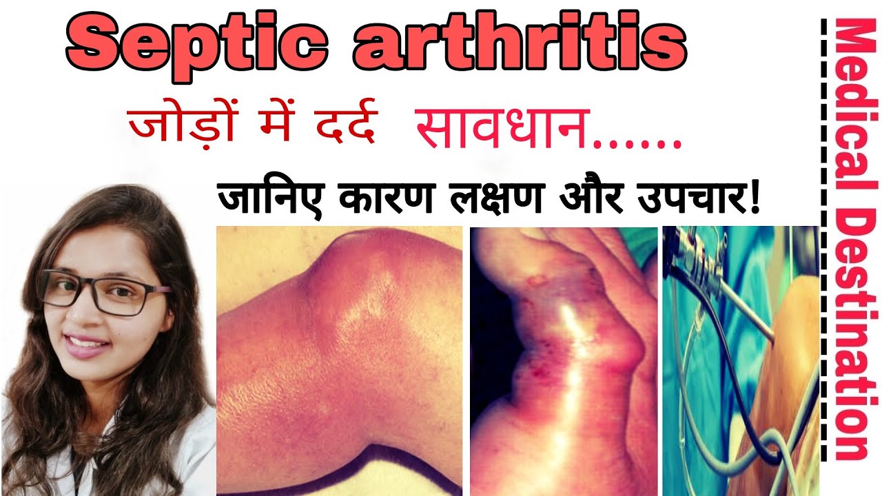 Septic arthritis  | causes | symptoms | investigation & treatment in hindi | medical Destination |
