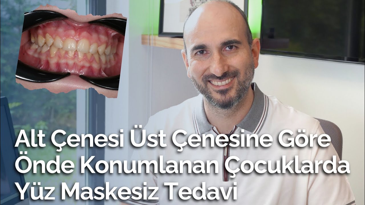 ALT ÇENESİ ÜST ÇENESİNE GÖRE ÖNCE KONUMLANAN ÇOCUKLARDA YÜZ MASKESİZ TEDAVİ - DR. CANER BALTA