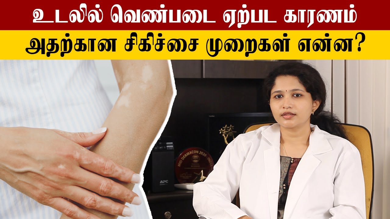 How to Cure Vitiligo | வெண்படை போக்குவது எப்படி? | Samayam Tamil