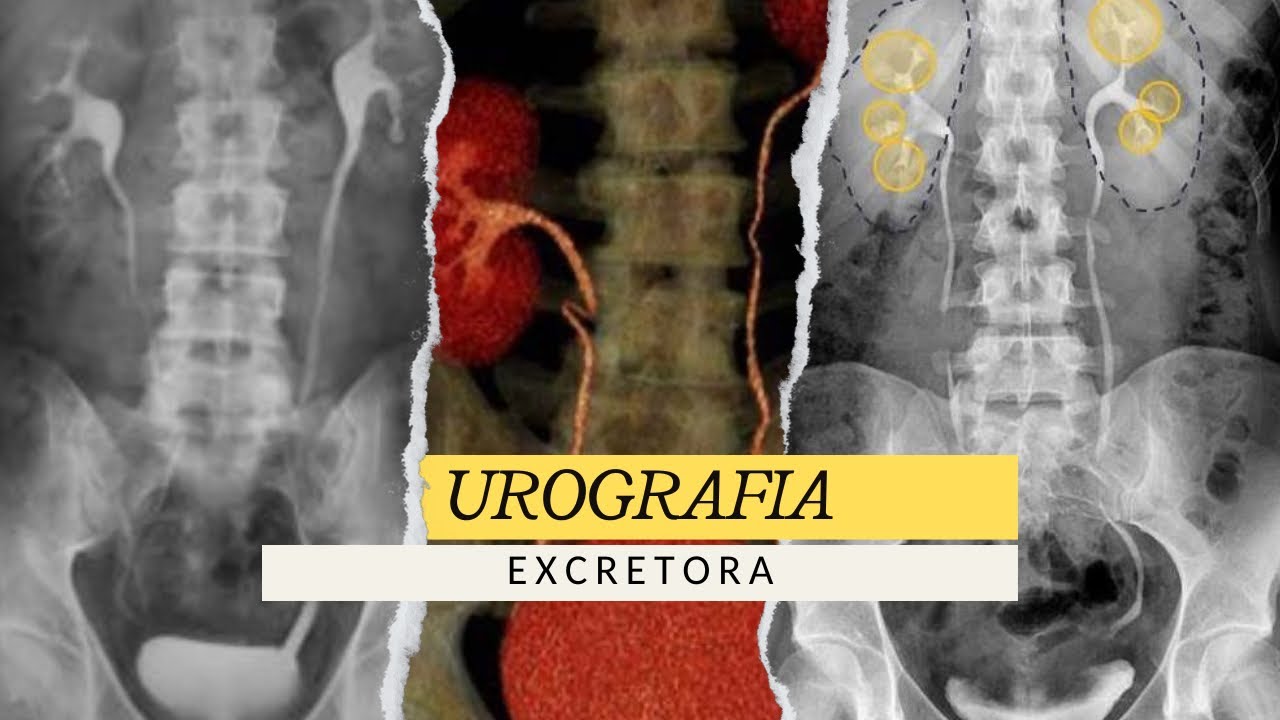 UROGRAFIA EXCRETORA | ESTUDIO RADIOLÓGICO #radiologia #radiology #medico