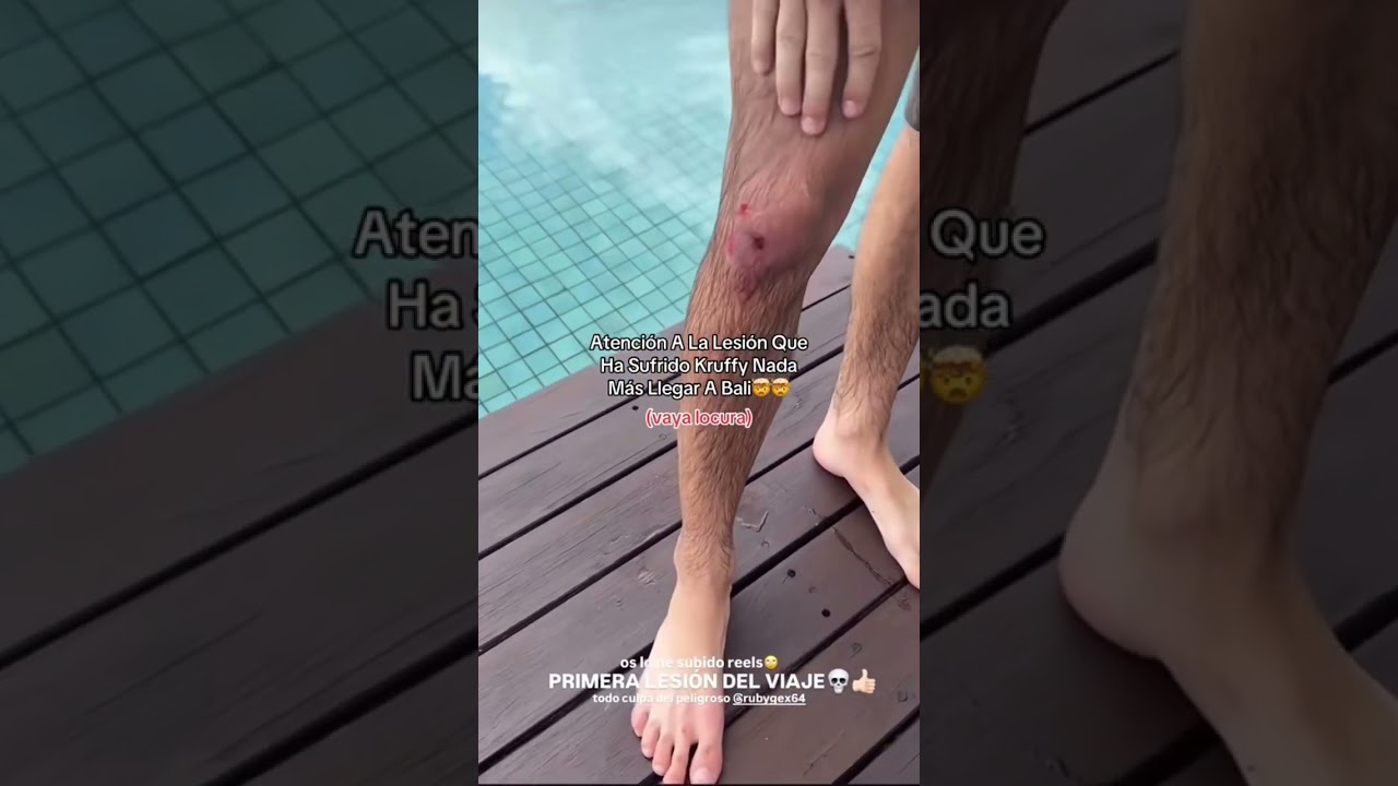 Kruffy se lesiona nada m&aacute;s llegar a Bali con Plex #plex #aitanax #kruffy