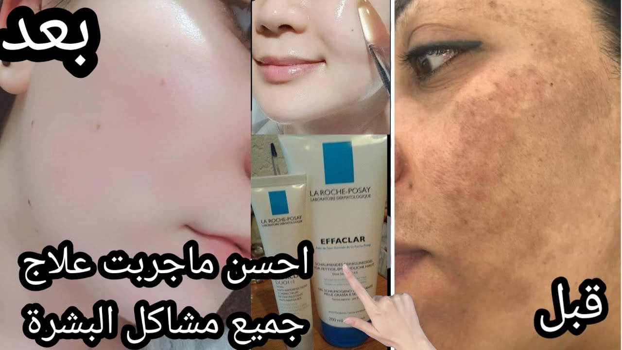 علاج  نهائي الكلف القديم والنمش بهاد برودوي لي غادي يهنيك كيف ما هناني