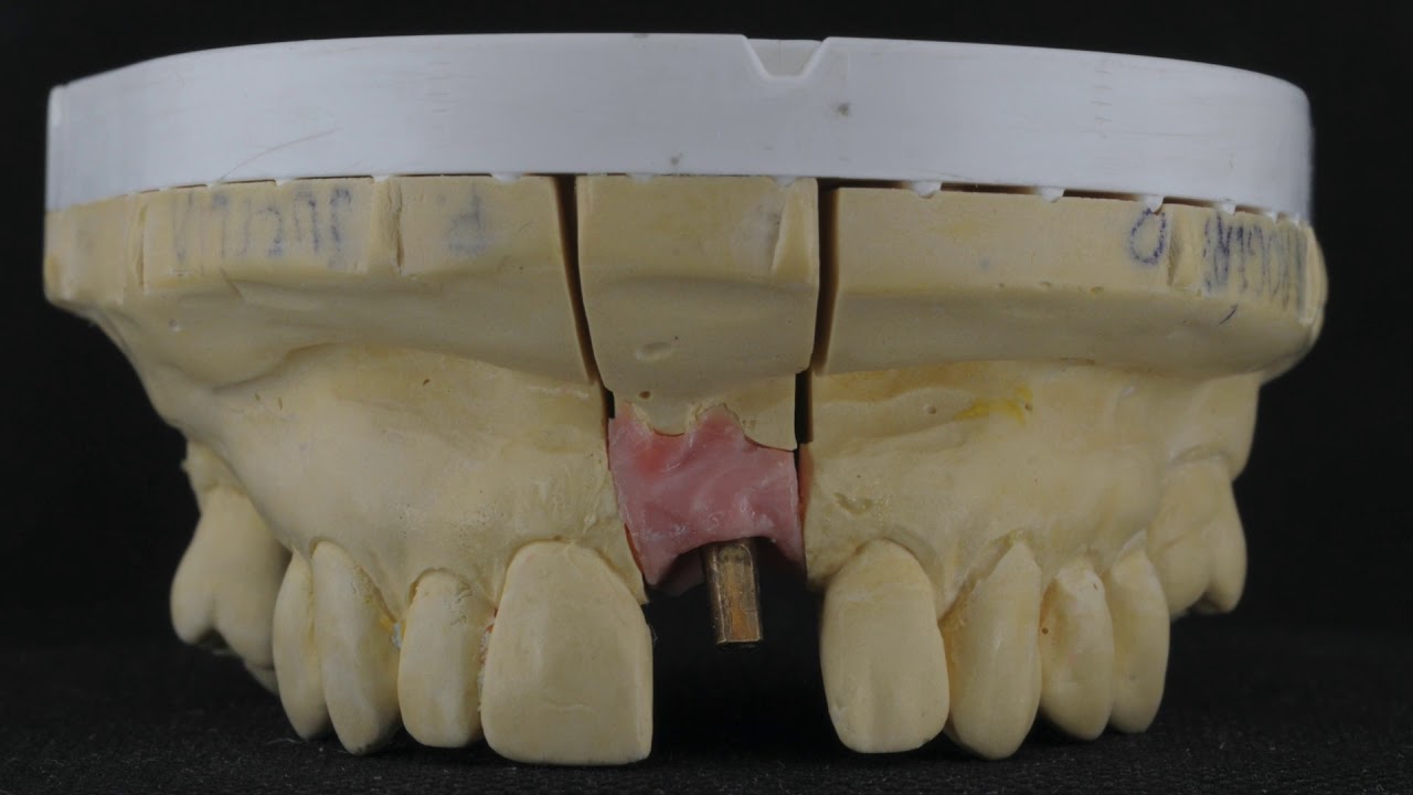 Obtenção do Modelo de Gesso para Prótese Sobre Implante Unitária
