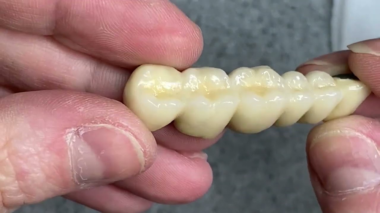 Upper PFM Bridge Buildup Grind Glaze