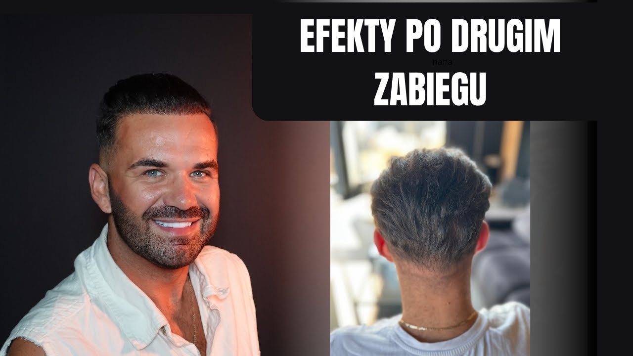 Drugi przeszczep - efekty po roku 🔴