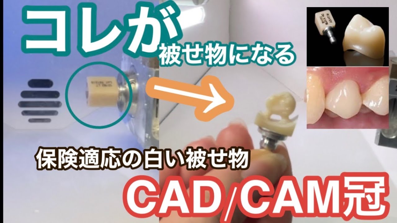 CADCAM冠(保険の白い歯)できるまで