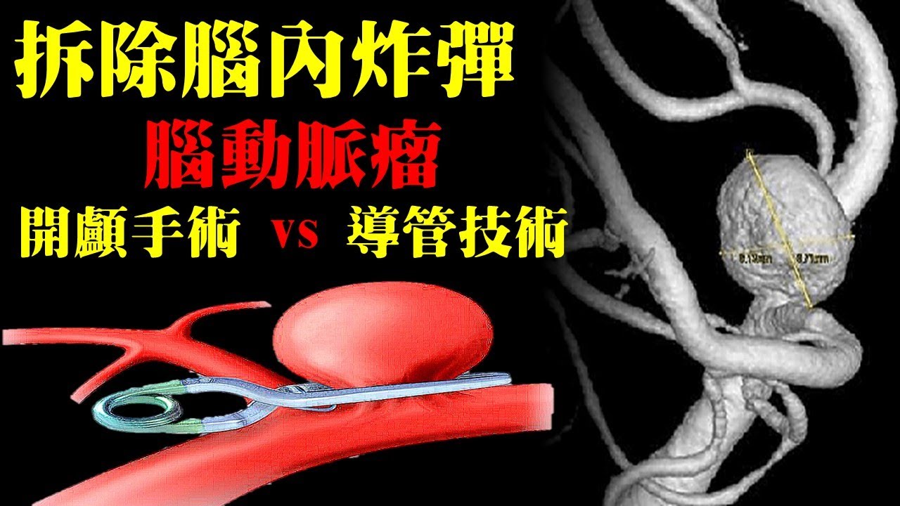 拆除腦內炸彈，傳統手術與導管技術，腦動脈瘤的檢查與治療｜許原彰醫師：高雄宇成診所
