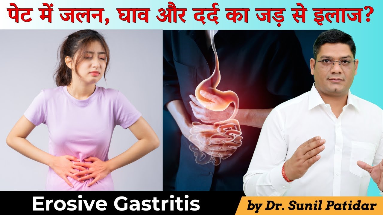 पेट में जलन, घाव और दर्द का जड़ से इलाज? | Erosive Gastritis Homeopathic treatment |Dr Sunil Patidar