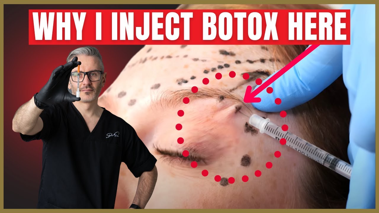 Как колоть ботокс под бровь | Советы по подтяжке бровей с помощью ботокса