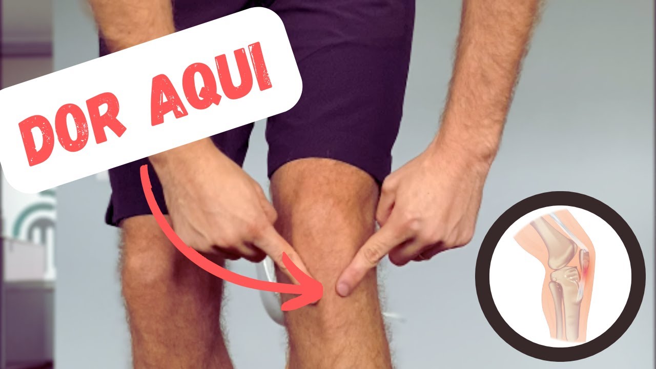 Tendinopatia Patelar, Tendinite ou Joelho de Saltador | Exercícios, Tratamento e Cirurgia