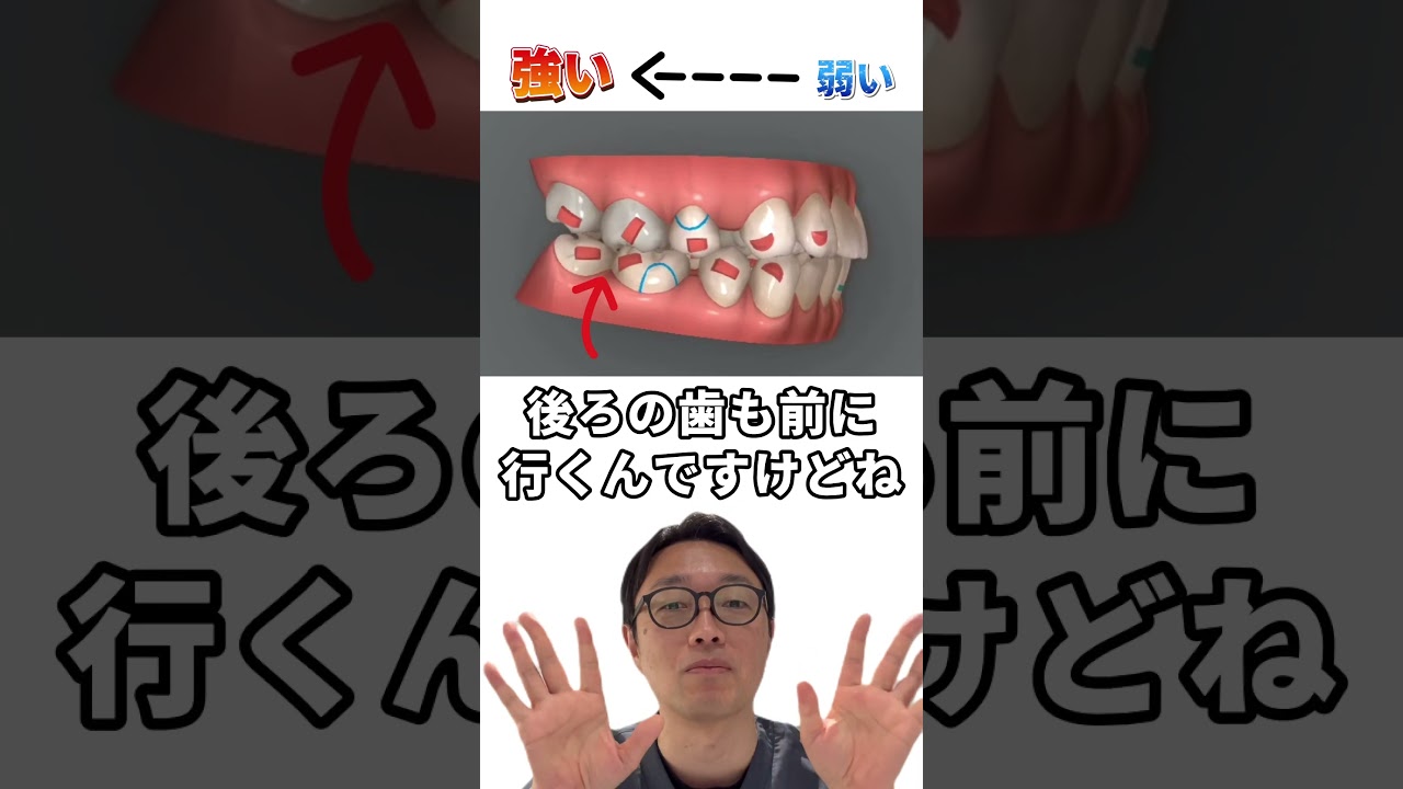 【解説編】抜歯矯正で横顔綺麗なＥラインに！#福岡ma矯正歯科 #マウスピース矯正 #抜歯矯正 #Eライン #インビザライン #歯並び #shorts