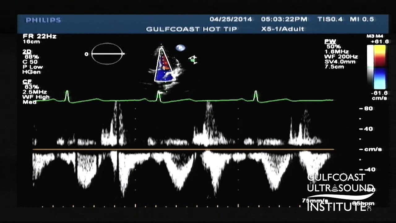 Hot Tips - Calculating the Aortic Valve Area Using the Continuity Equation