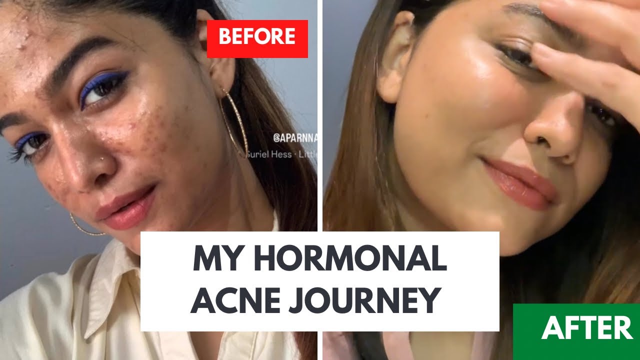 They said my acne would never go.. Well, My Skin is in comeback Era! Skin Journey fully explained!