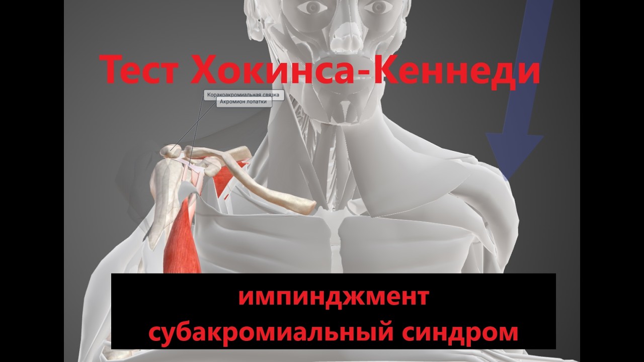 Тест Хокинса-Кеннеди Импинджмент синдром плеча