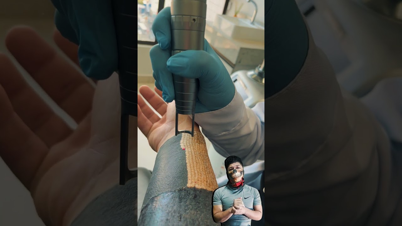 Quieres Borrar tu Tatuaje sin Dolor? Descubre el M&eacute;todo M&aacute;s Avanzado #tatuajes #laser #shorts