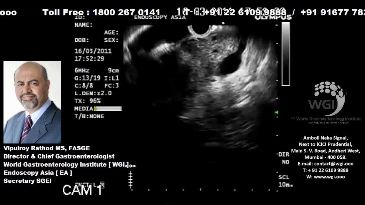 Endoscopic procedure of pancreas Mass