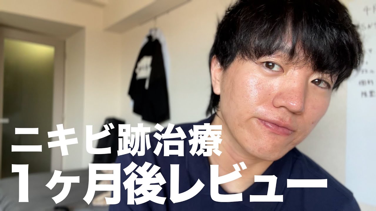 史上最強のニキビ跡治療の１ヶ月後レビュー(クレーター)と太郎って今何してるん？？って言う話