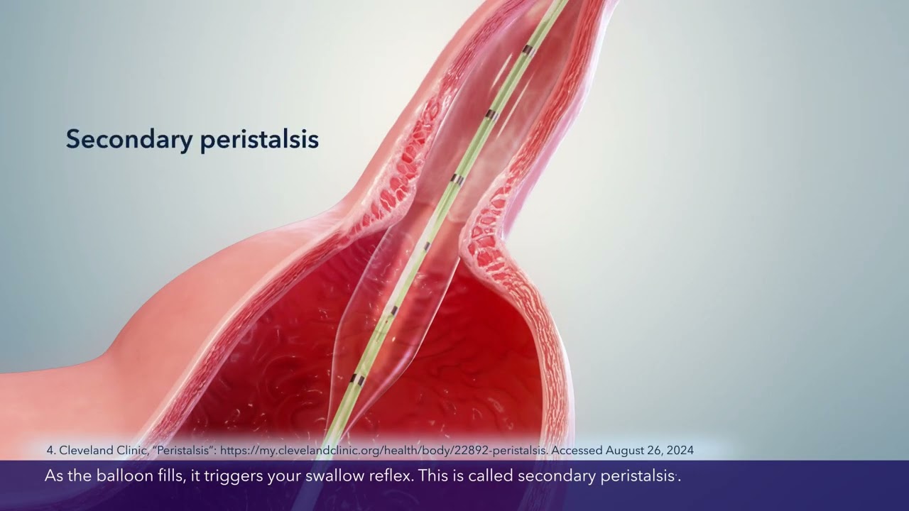 Endoflip™ procedure animation