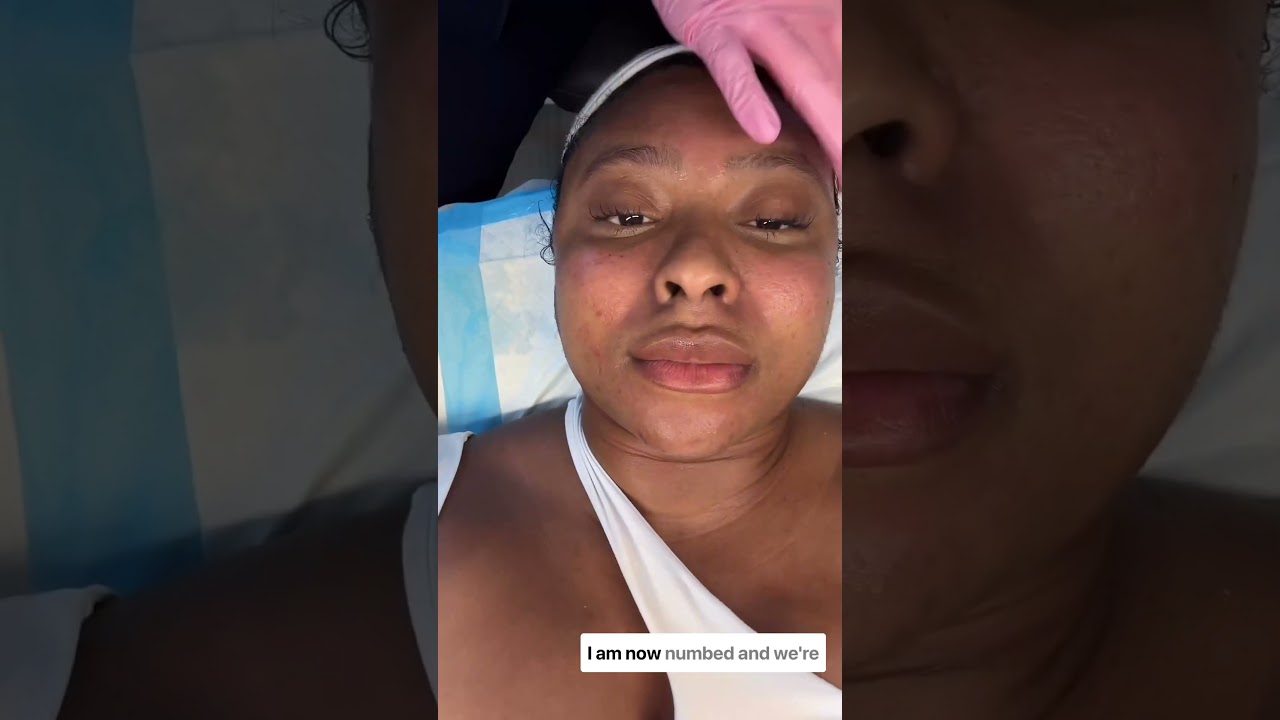 Best SkinPen Microneedling in Dallas: Angelica's experience at Sanjiva Med Spa in Dallas