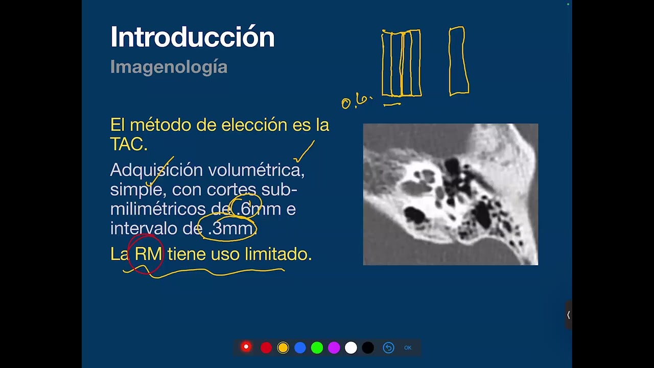 Imagenología en la Otoesclerosis