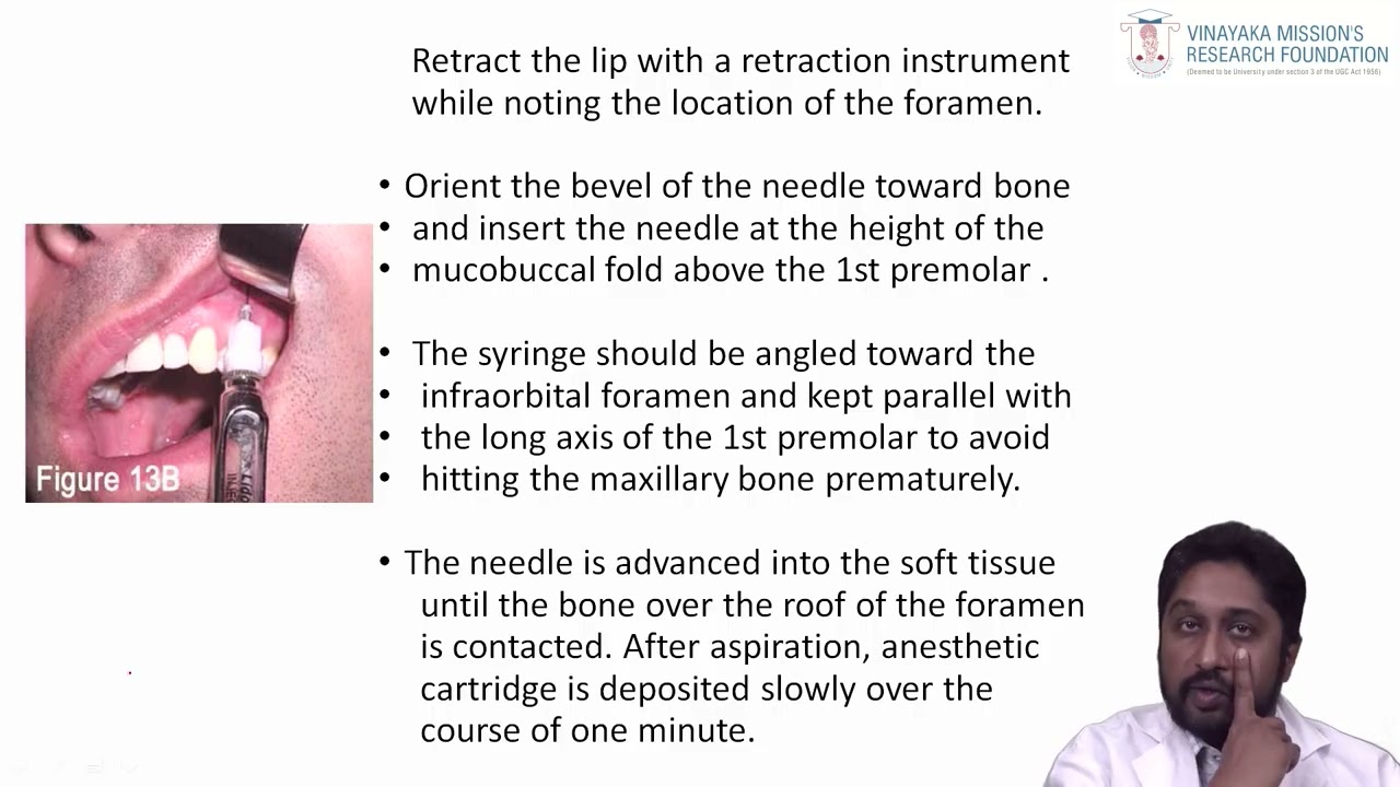 Maxillary Nerve Blocks