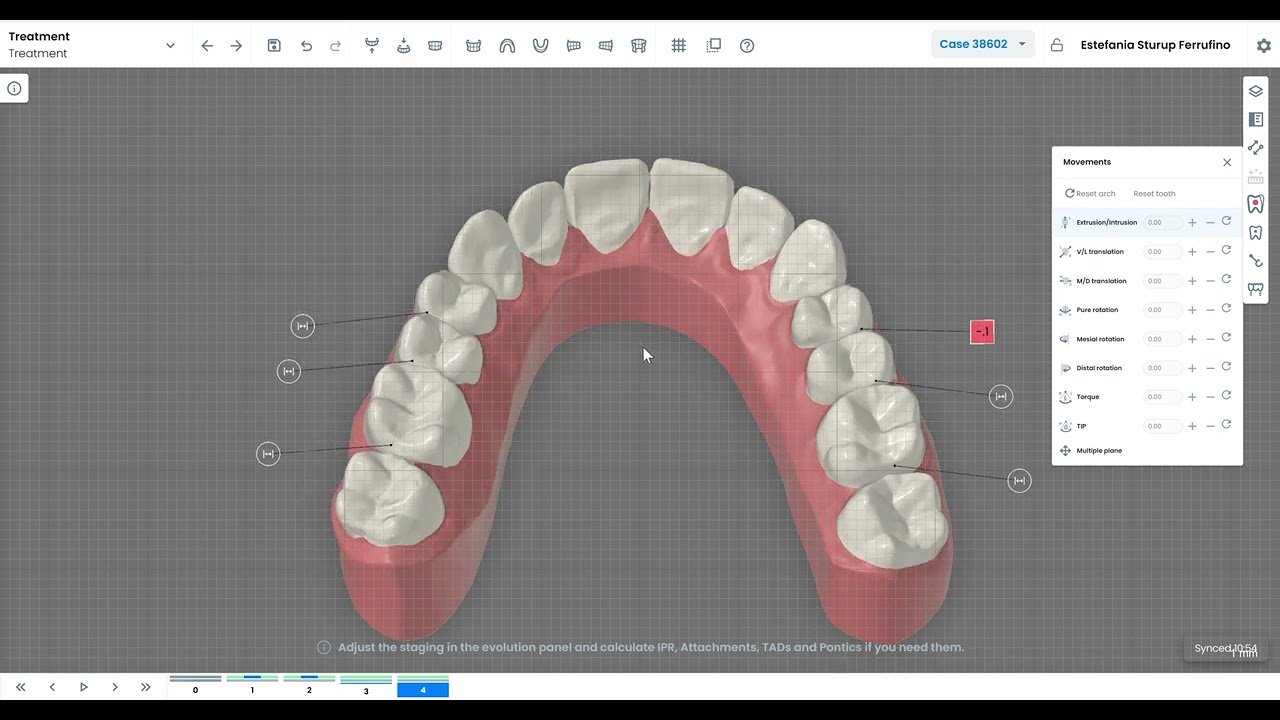Moderate crowding case in just 15 min with Dendisign