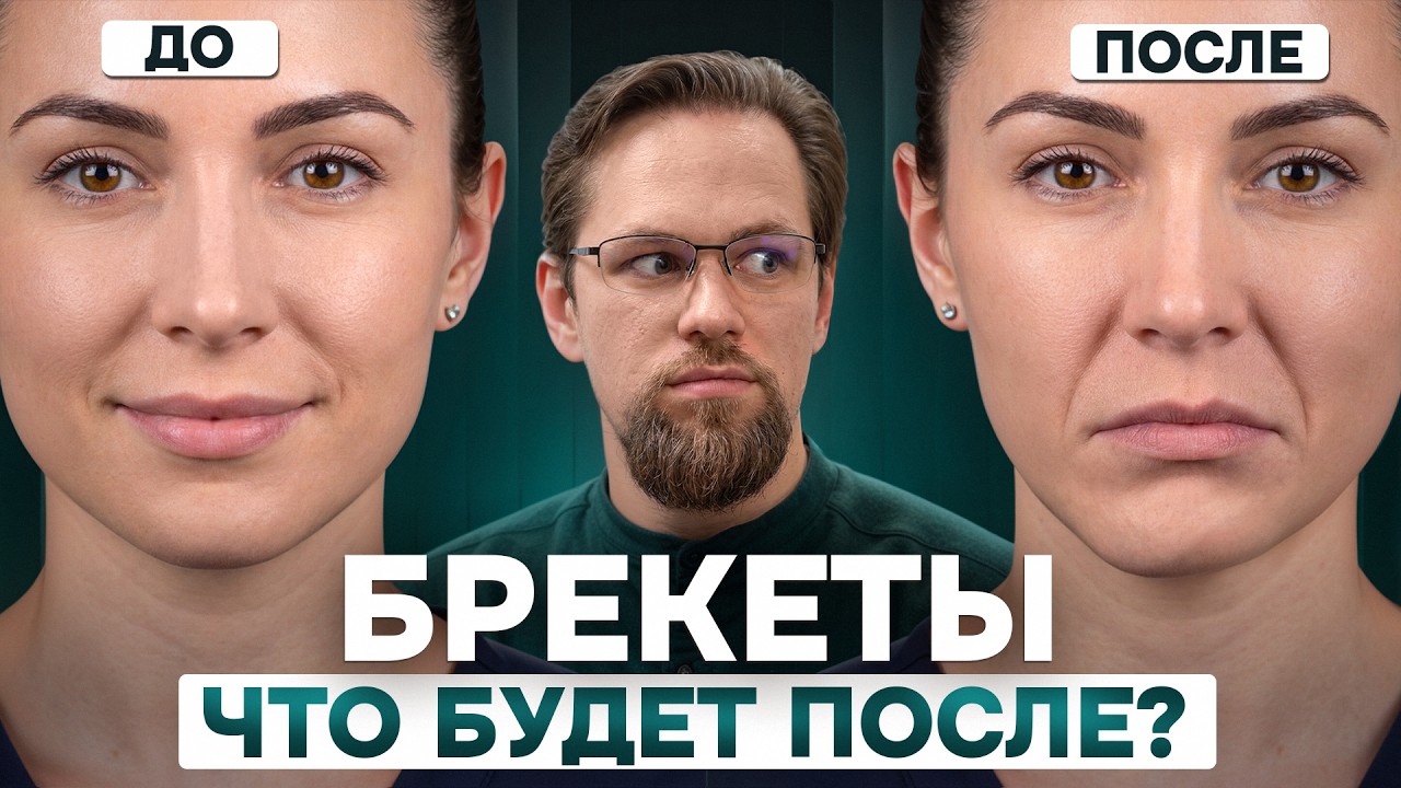 О чём стоматологи не говорят перед установкой брекетов?
