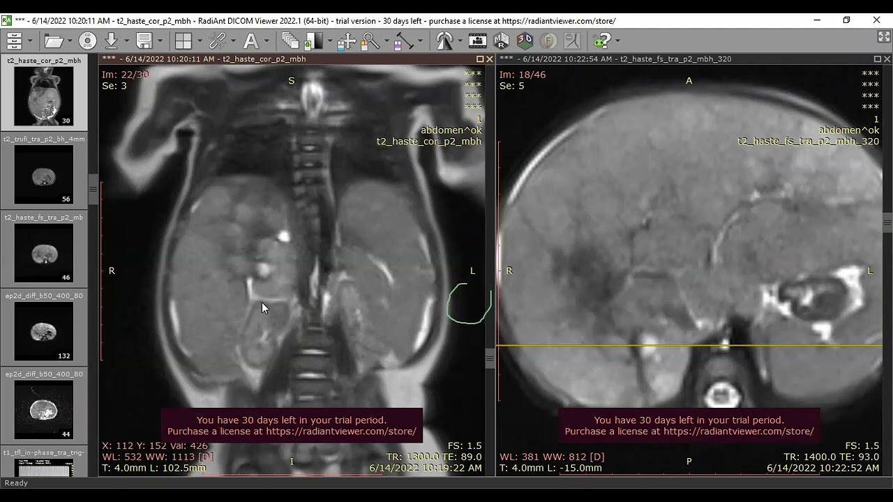 Neuroblastoma with liver metastases