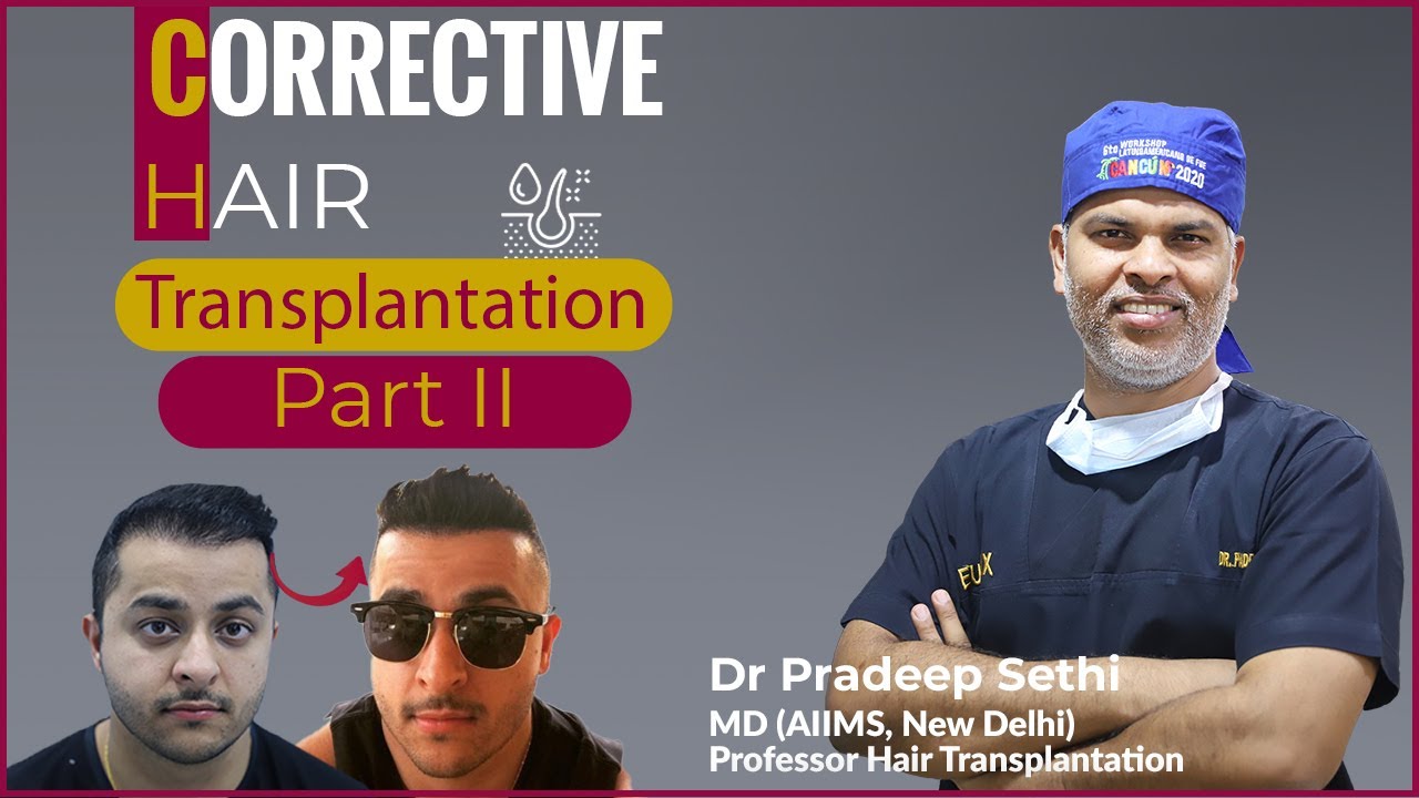 Corrective Hair Transplantation @EugenixHairSciencesofficial, India - By Dr. Pradeep Sethi (Part II)