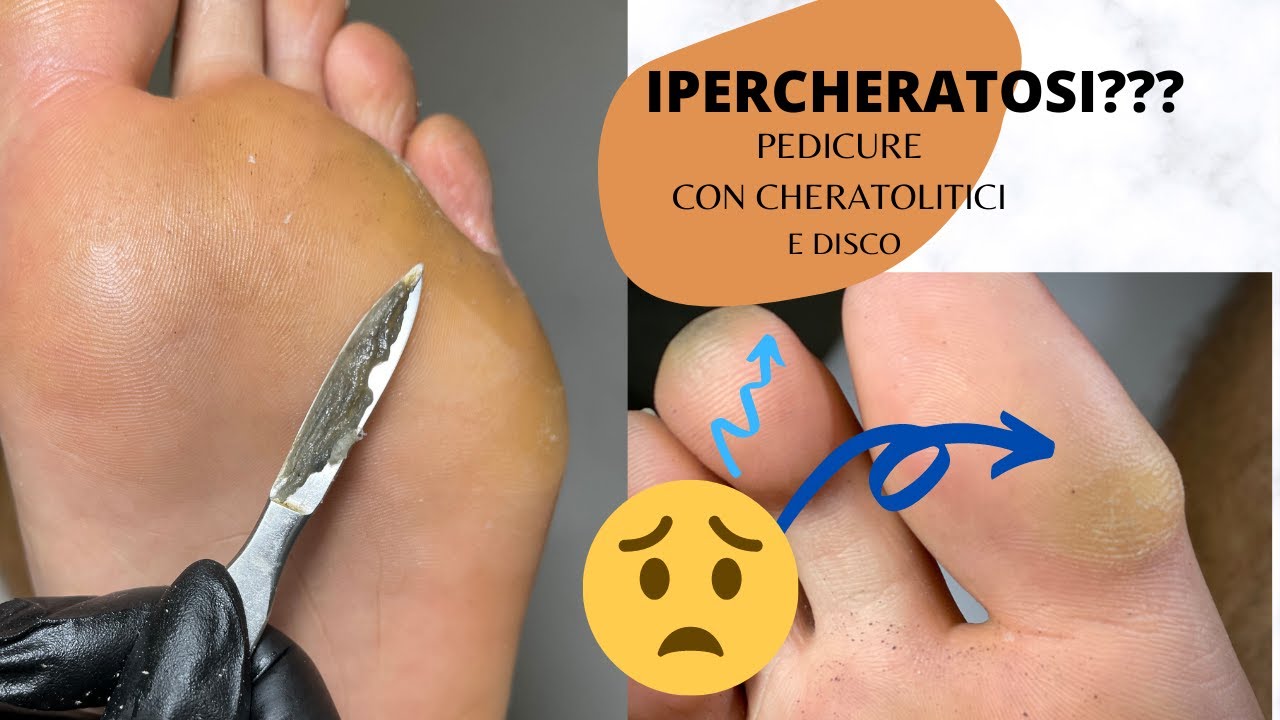 👣PEDICURE / 🆘✅ IPERCHERATOSI / Cos'e? e come rimuoverla/