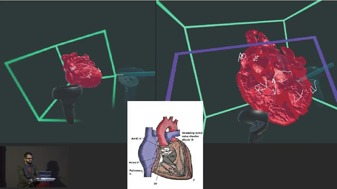 Role of 3D Reconstruction and Virtual Realityin Surgery for DORV - Mahesh Kappanayil