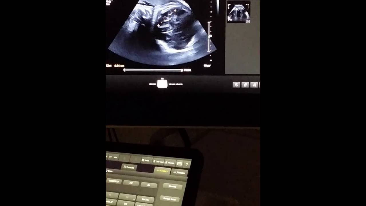 Bébé 34 semaine 4 jours