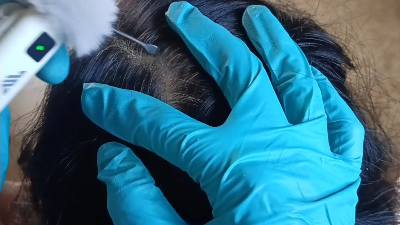 ASMR: Dry, Itchy Scalp with Dandruff Removed by Scratching