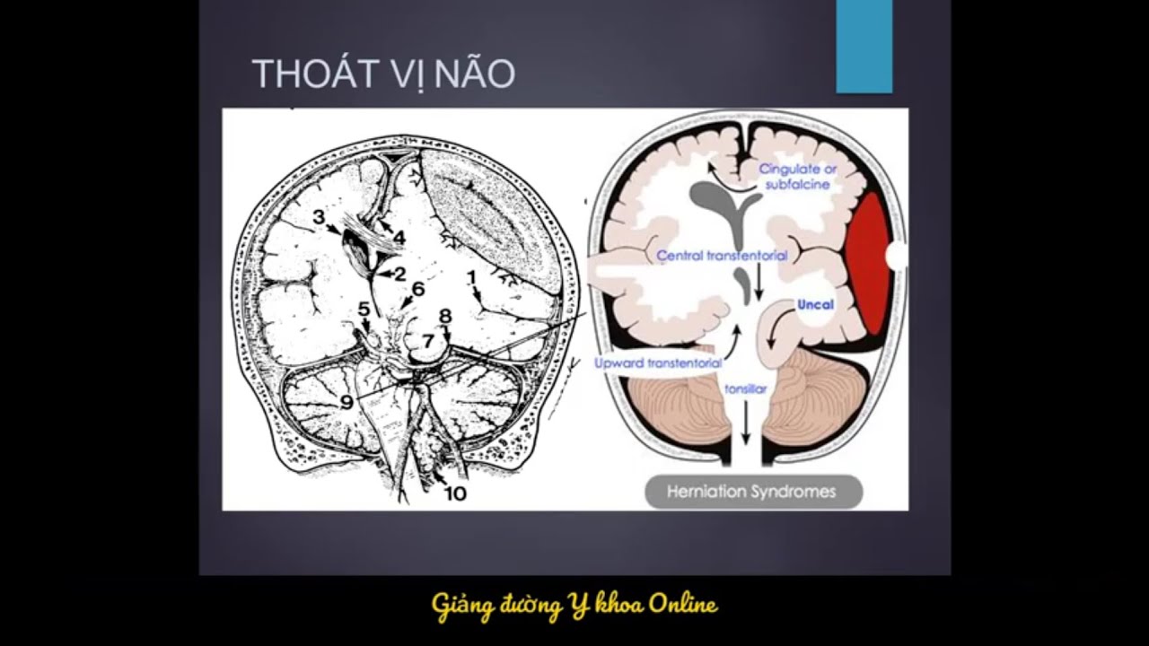 ĐỌC PHIM CT CHẤN THƯƠNG SỌ NÃO | Bs. Trần Quý Tường