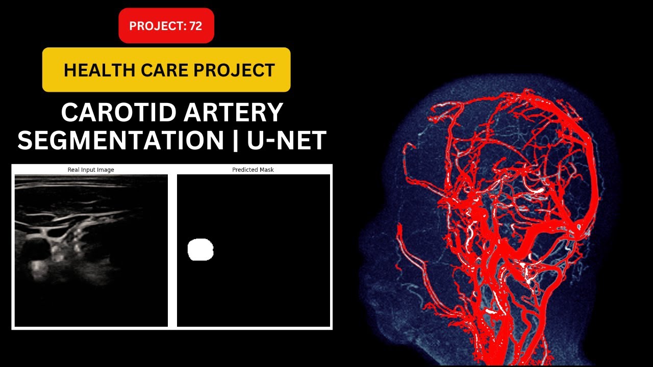Project 72 : Carotid Artery Segmentation Using U-NET | Deep Learning in Medical Imaging