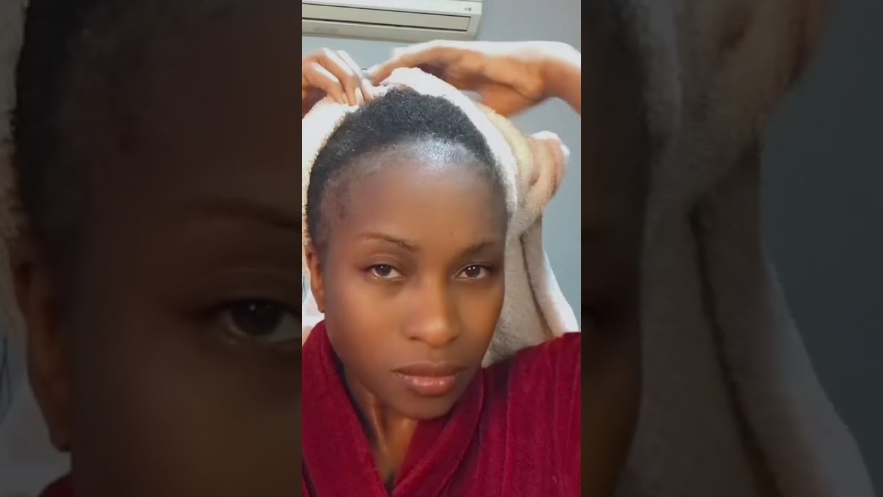 What Stops EXCESSIVE Shedding When Using Minoxidil Treatment?