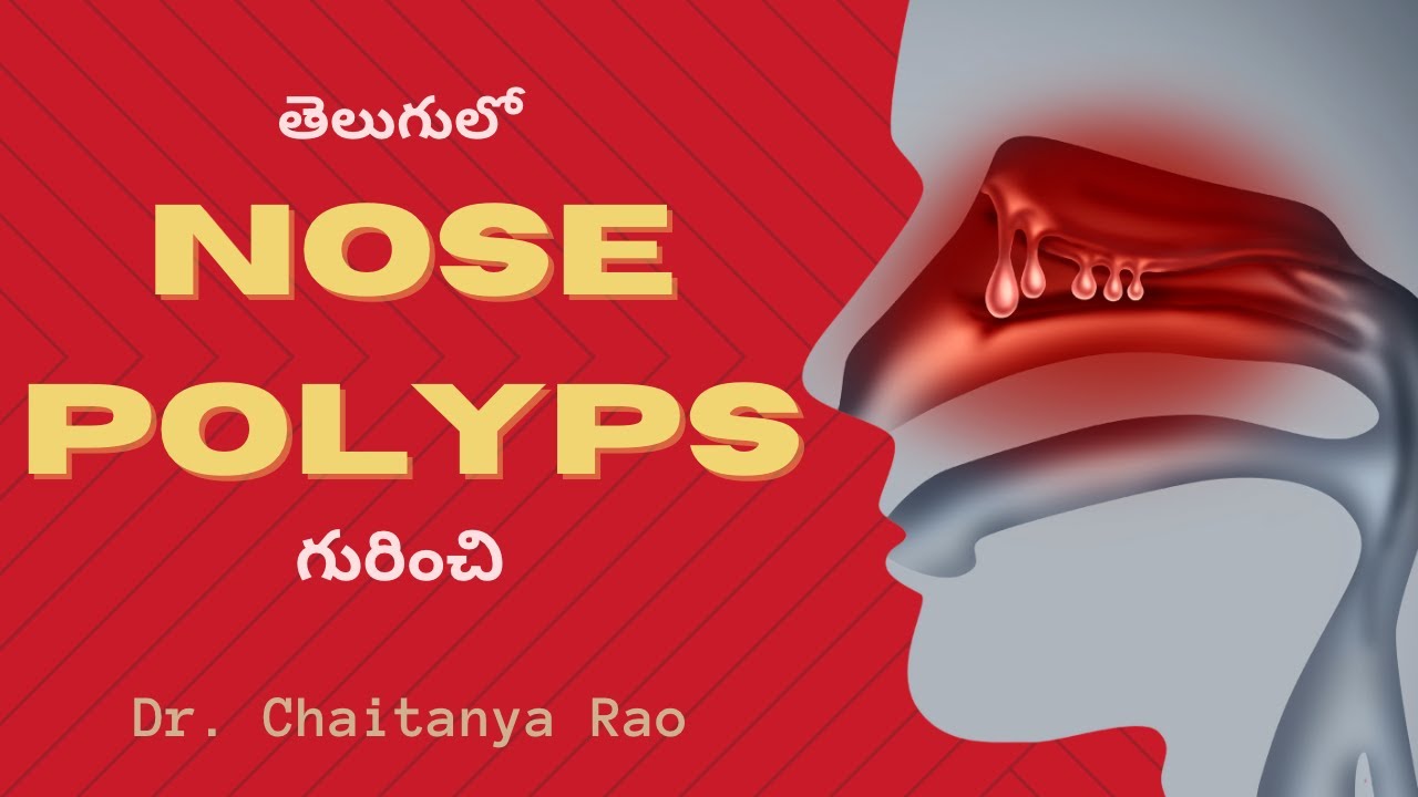 నాసల్ పాలిప్స్ కి అంతిమ పరిష్కారం | Nasal polyps breakthrough Rx
