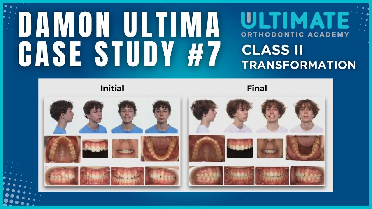13-Month Class II Transformation: Fast, Predictable, and Esthetic | Paul’s Orthodontic Case Study