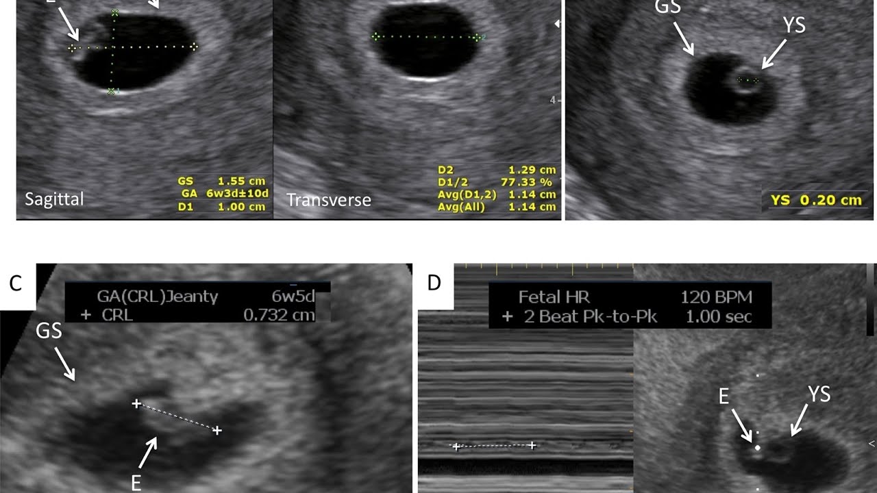 Gestational Age from Gestational Sac.
