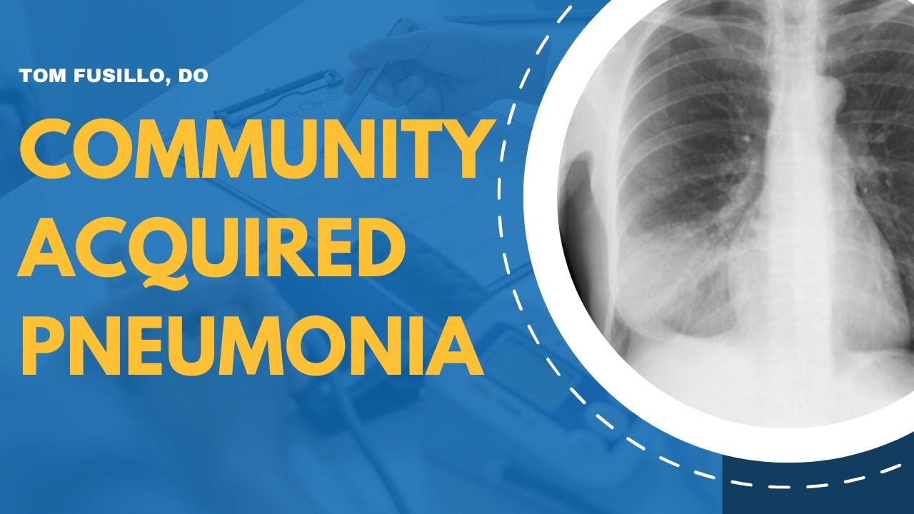 Community Acquired Pneumonia | Bacterial vs Viral, Diagnosis, and Choosing Antibiotics for Treatment