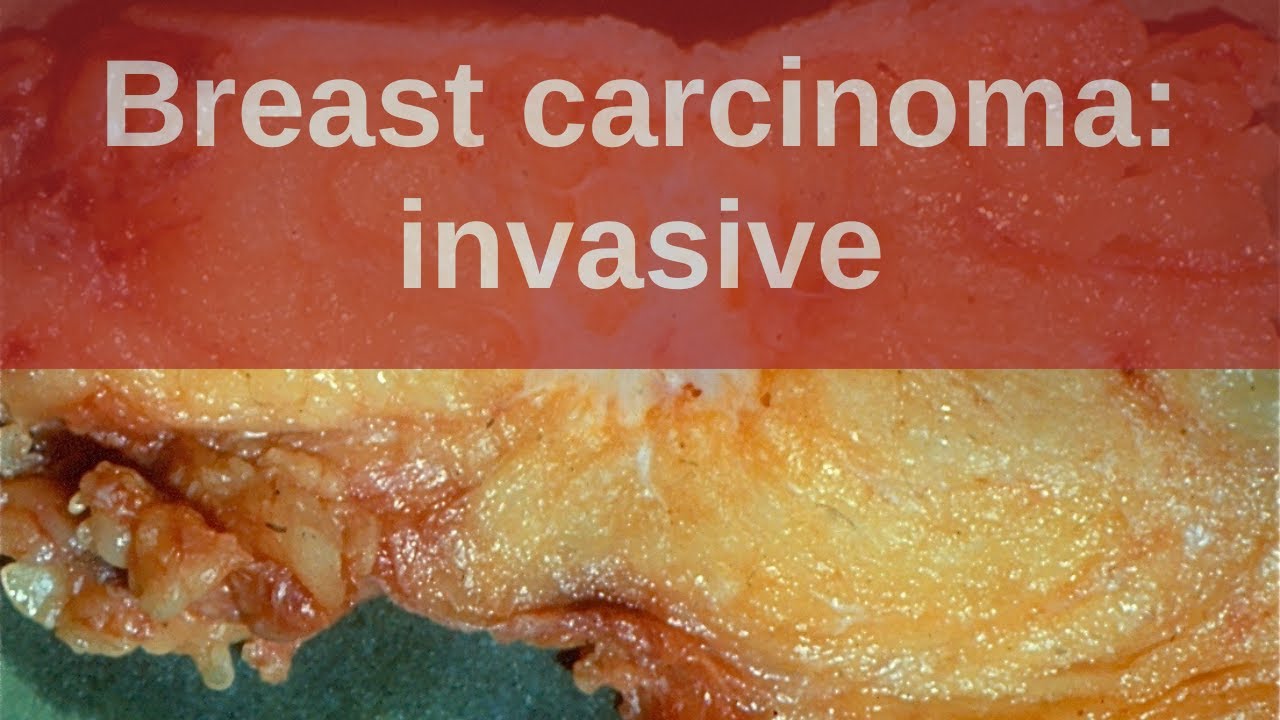 Breast Carcinoma: Invasive - Pathology mini tutorial