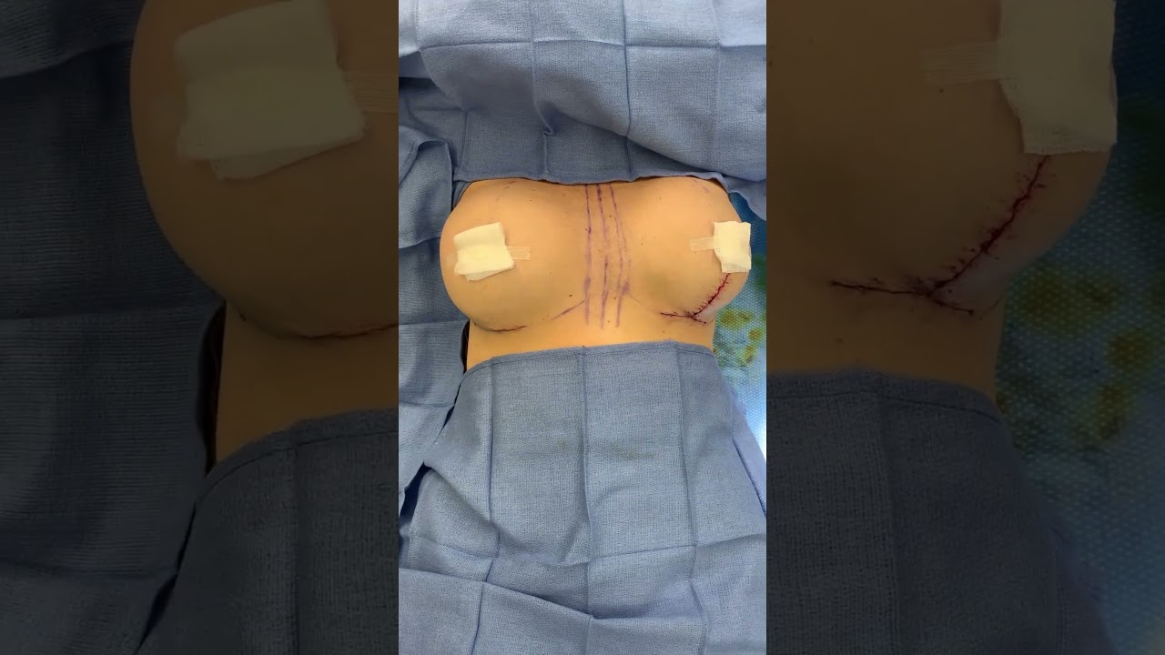 Breast Implants with One Sided Lift! #mastopexy