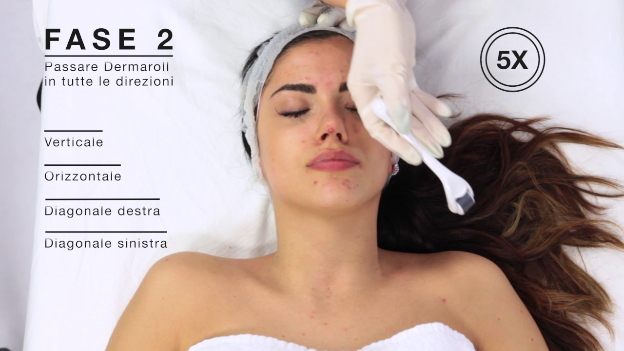 RIGENERA - MICRONEEDLING