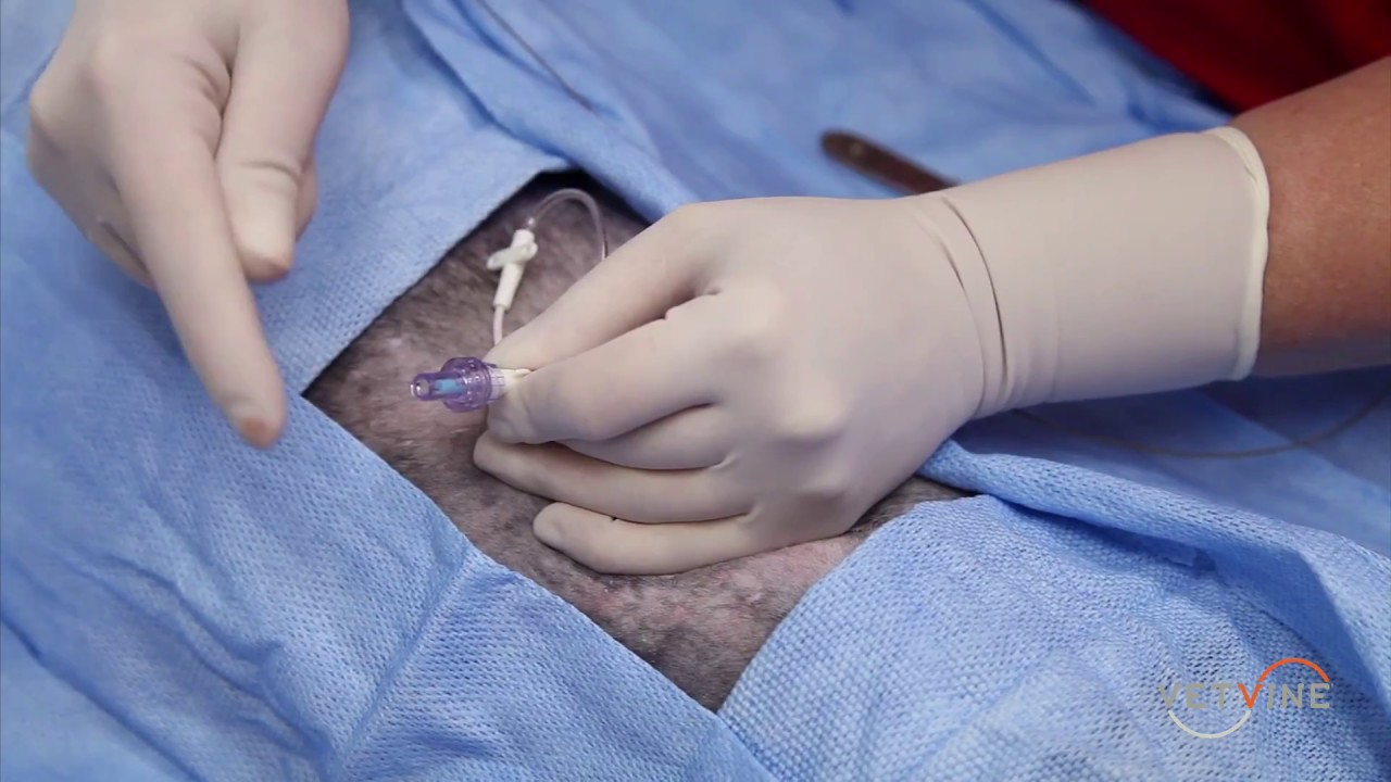Chest Tube Placement:  Over-the-Wire Technique