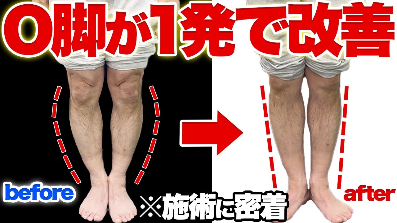 【O脚矯正】足の歪みを悶絶整体で1発改善【O脚・XO脚・膝下O脚】