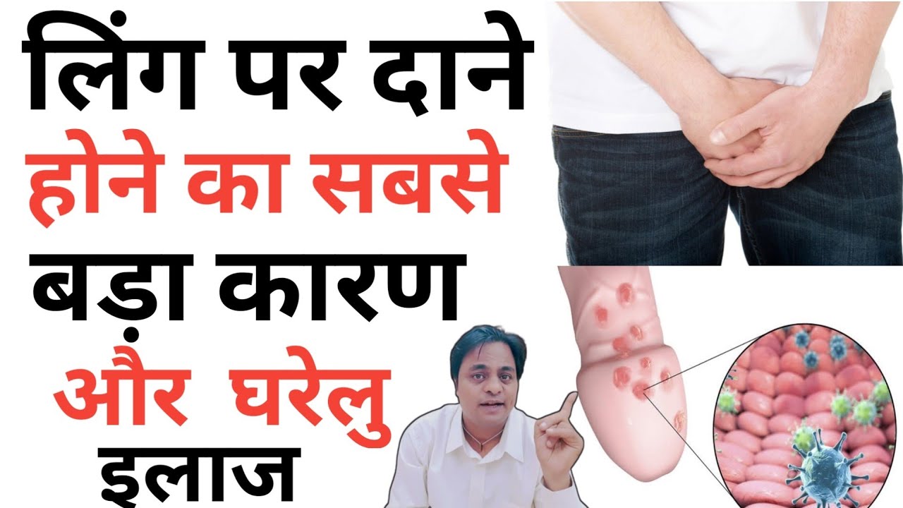 L*ing Par Dano Ka Ilaj। Main Part Par Dano ka ilaj। Safed Dane Private Part Par Ho Jaye To Kya Kare