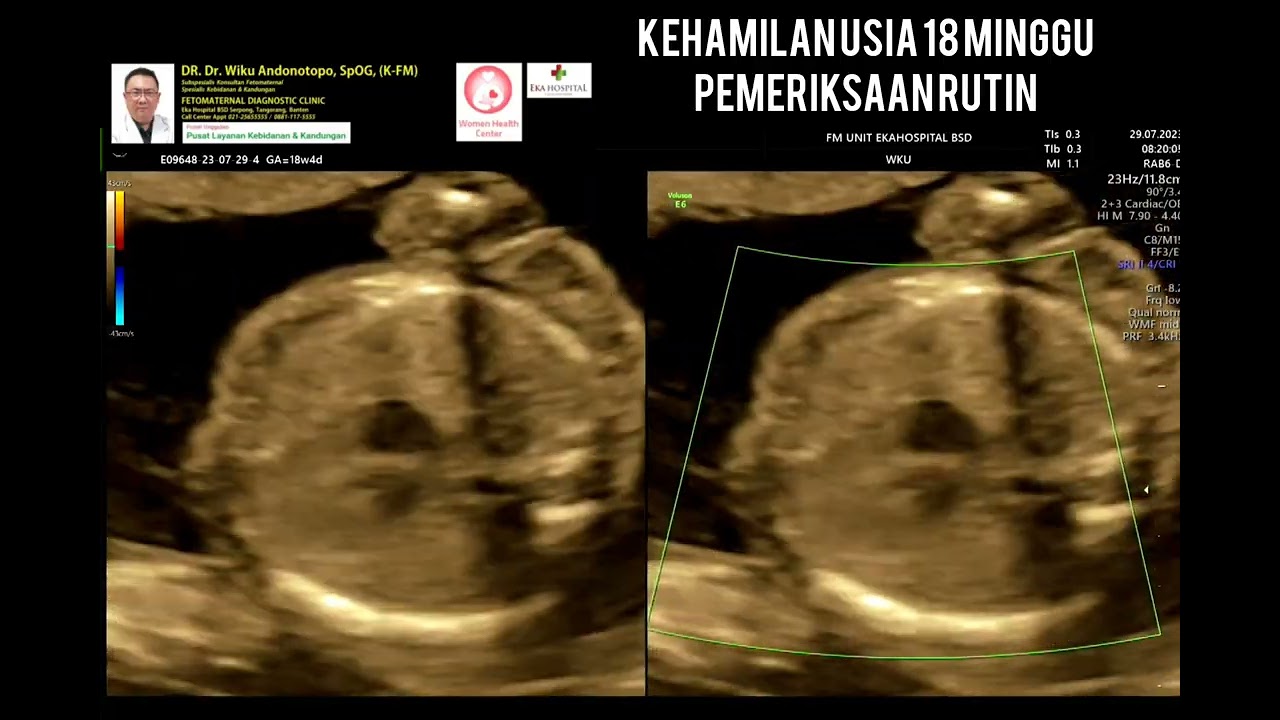Kehamilan 18 minggu
