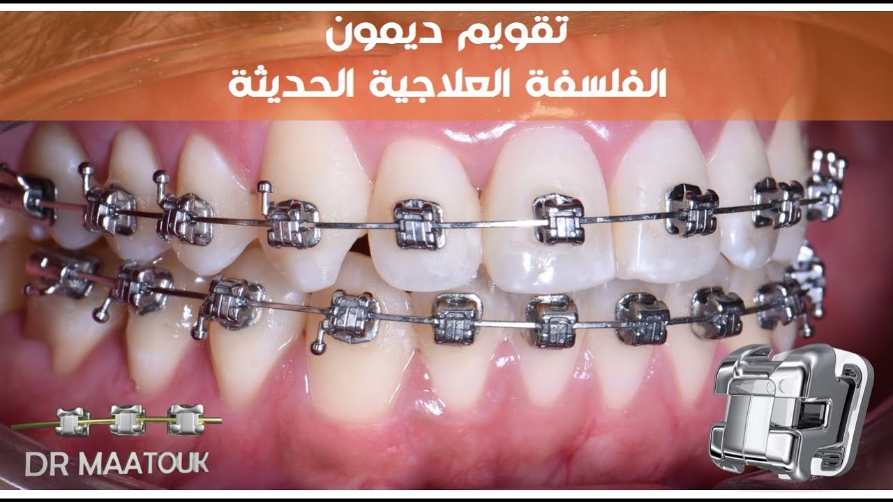 تقويم ديمون. الفلسفة العلاجية الحديثة. Damon system braces. The new orthodontic philosophy.