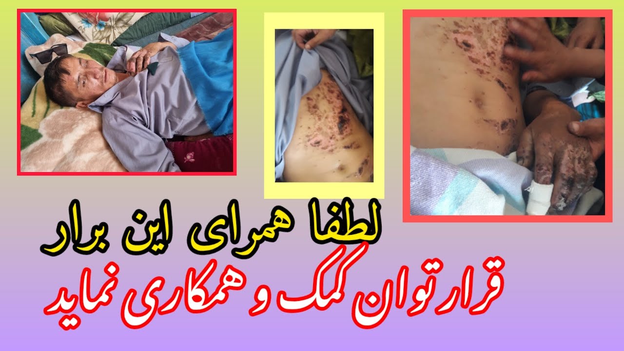 وضعیت حبیب الله که در چاه بالایش انفجار صورت گرفته این قرار است لطفا قرار توان همکاری نماید 